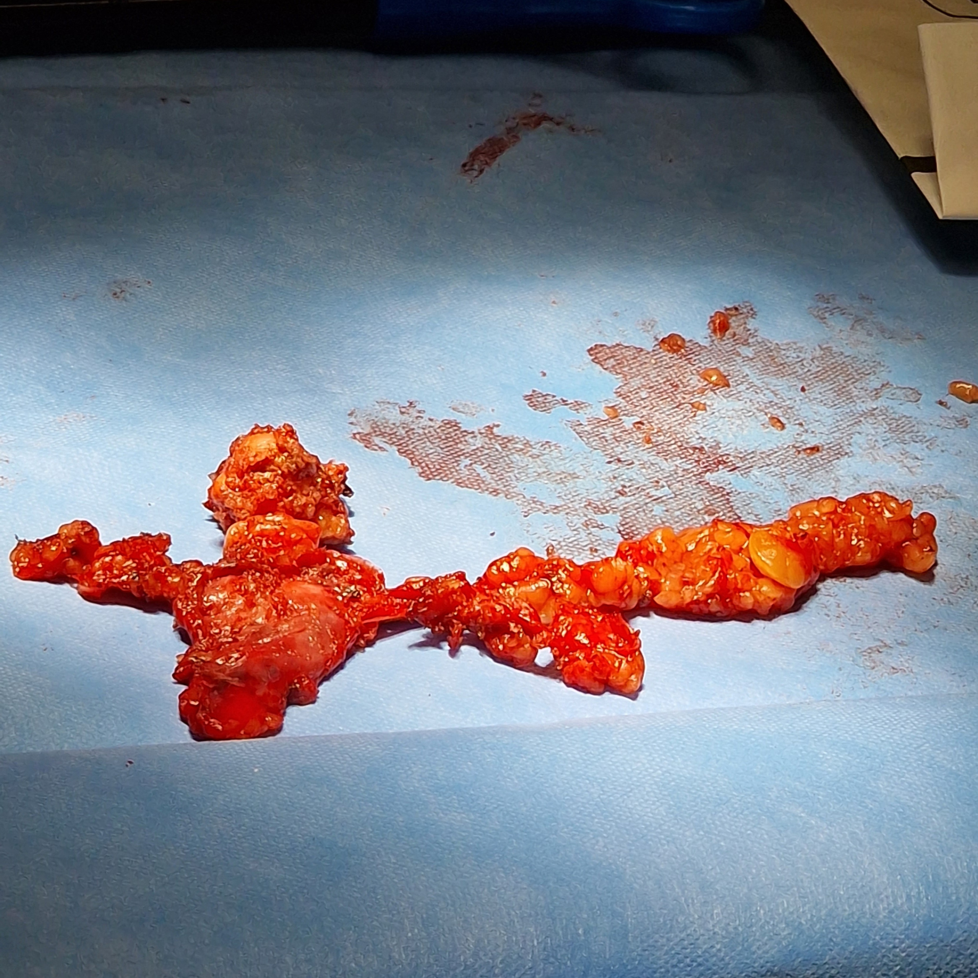 Robotic total Thymectomy and Resection of Anterior Mediastinal Mass